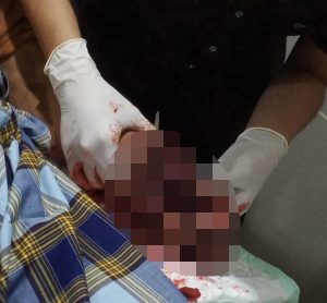 Ledakan Petasan Rakitan Sendiri Tangan Seorang Sekuriti Hancur
